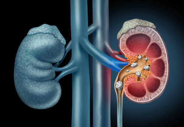 kidney stones treatment
